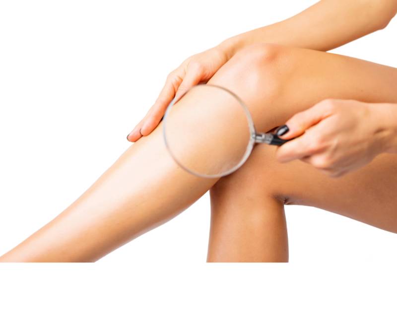 Épilation définitive des jambes par laser en cabinet médecine esthetique à Cuers 