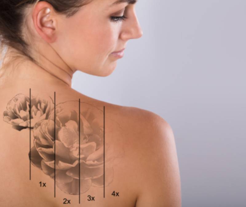 Promo sur la première séance de détatouage au centre Athéna Aesthé 