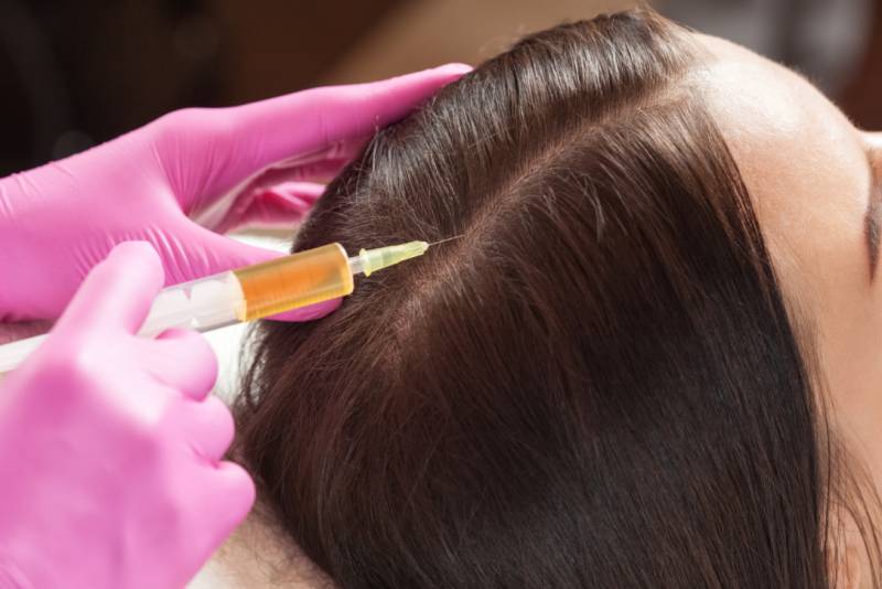PRP pour le traitement de la chute de cheveux