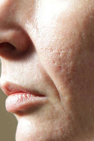 Cicatrices d’acné : dites adieu aux marques visibles chez Athena AESTHE à Cuers, proche de La Crau