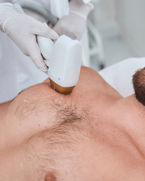 Épilation laser du dos pour les hommes à Cuers – Athéna Aesthé, votre allié pour un été sans poils