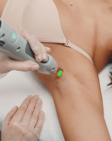 Combien de séances faut-il pour une épilation laser complète chez Athena AESTHE à Cuers dans le Var ?