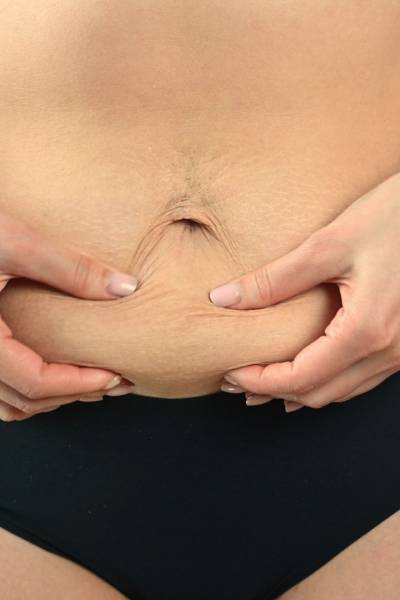 Retendez votre peau après une perte de poids chez Athena AESTHE à Cuers, proche de Toulon