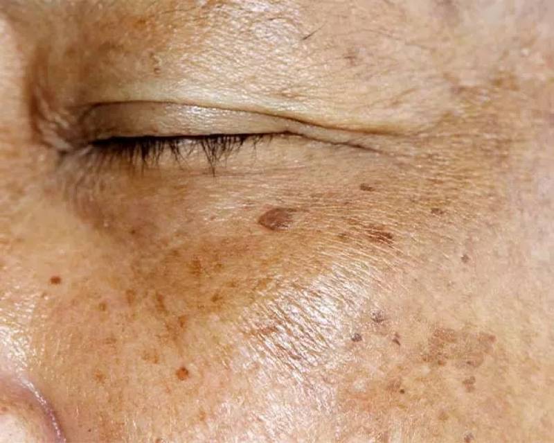 Traitement pour les tâches de vieillesse et l'anti-âge près de Toulon à Cuers Var