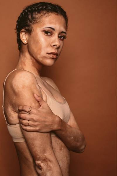 Taches pigmentaires : comprendre et traiter chez Athena AESTHE à Cuers, proche de Pierrefeu-du-Var